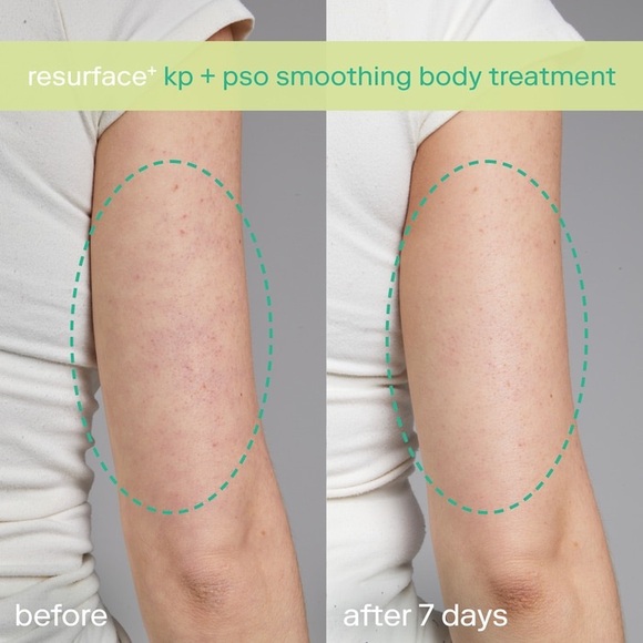🆕 SKINFIX - KP+ Psoriasis Smoothing Treatment Body Lotion 150 mL NIB